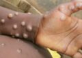 Rwanda-Monkeypox: le personnel médical de Gicumbi sur ses gardes