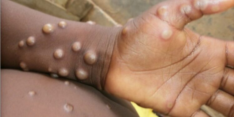 Rwanda-Monkeypox: le personnel médical de Gicumbi sur ses gardes