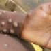 Rwanda-Monkeypox: le personnel médical de Gicumbi sur ses gardes