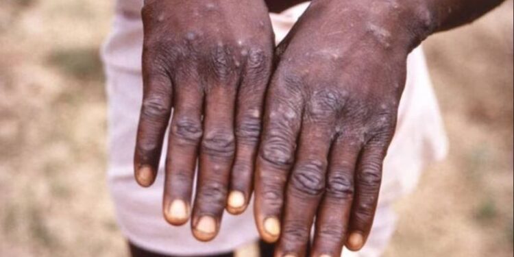 Rwanda-santé : Alerte sur la variole du singe (Mpox)