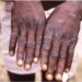 Rwanda-santé : Alerte sur la variole du singe (Mpox)