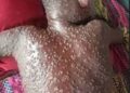 RDC : Mpox fait plus de 450 morts