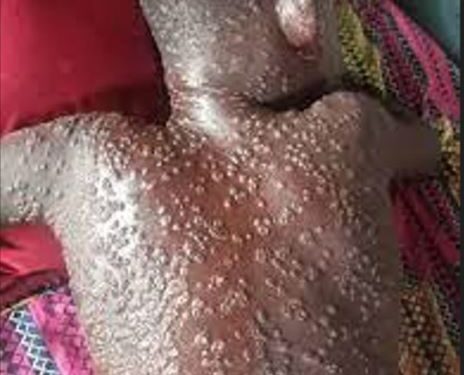 RDC :  Mpox fait plus de 450 morts