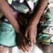 Mpox – Africa CDC: Appel à une action mondiale