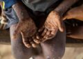 Mpox : 600 millions de dollars contre le virus