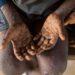 Mpox : 600 millions de dollars contre le virus