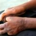 Santé- lèpre : appel au dépistage précoce